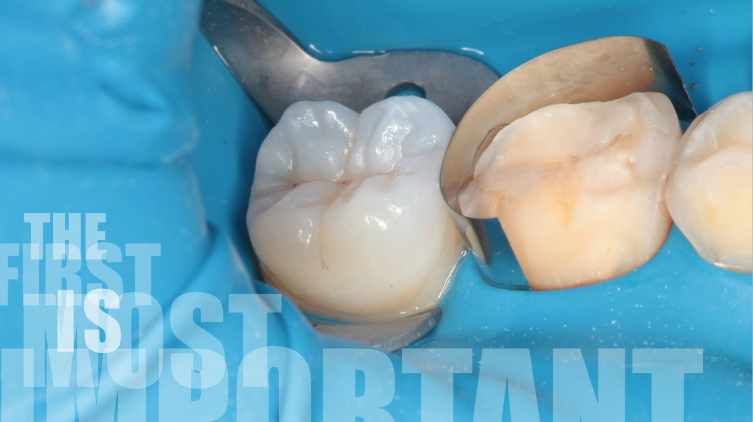 <span style="font-weight: bold;">Керамические накладки </span>